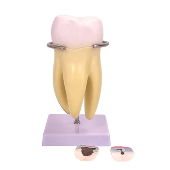 Zubné Anatómie Model Molekulová Zub Anatómie Model s Odnímateľnými Časťami Ľudského Zub Model pre Zubné Choroby Štúdia